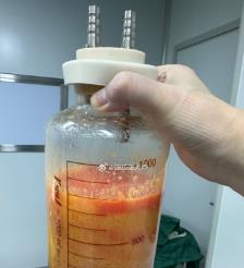 邹城水动力吸脂手术要做多久？
